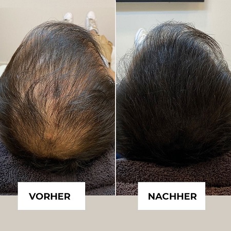 Ergebnisse einer Haarpigmentierung